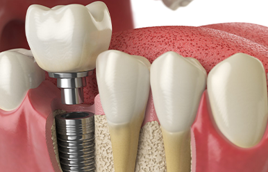 Dental Implants